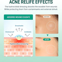 SOME BY MI - 30 Days Miracle Clear Spot Patch