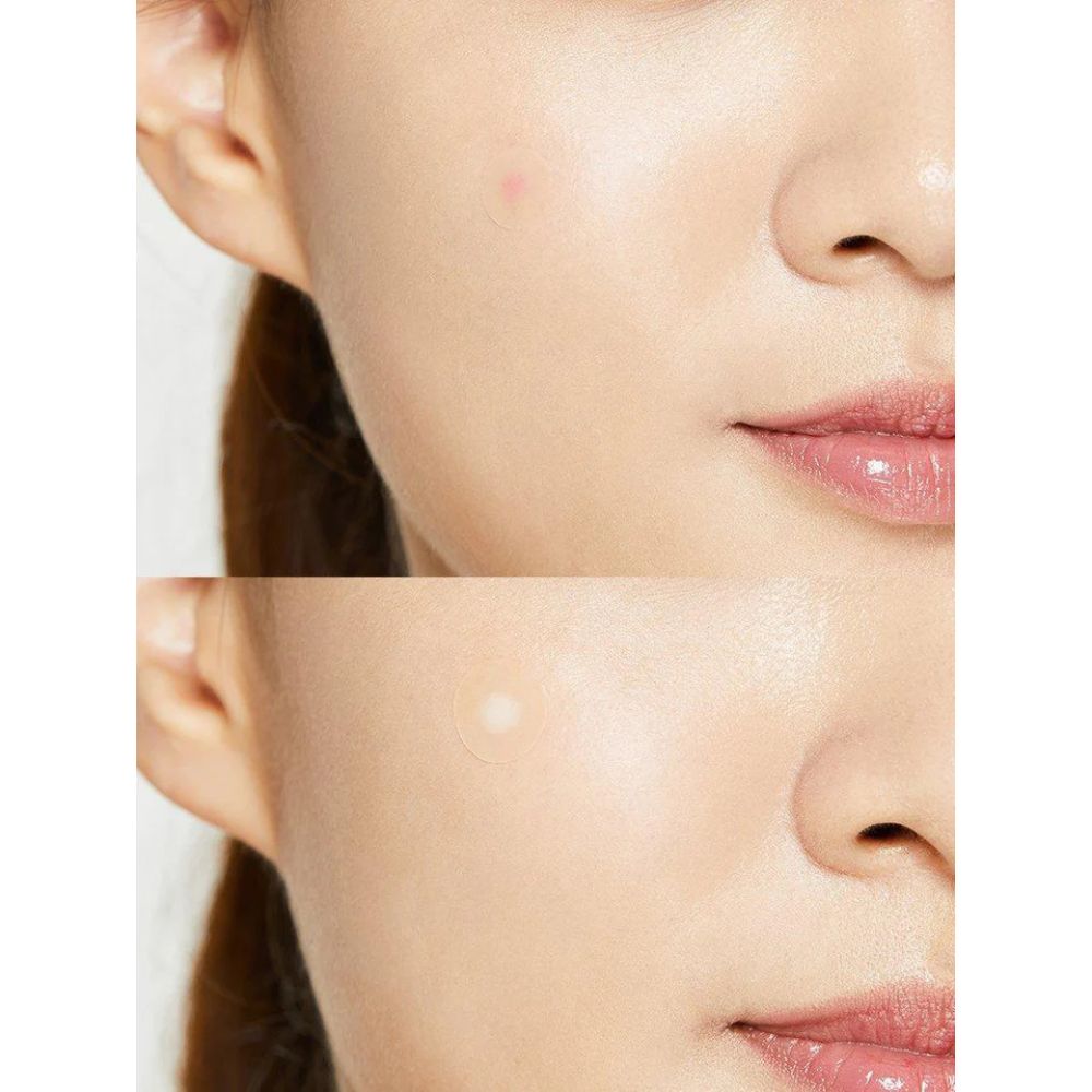 COSRX - Acne Pimple Master Patch